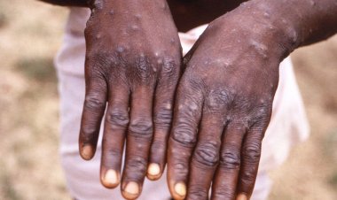 Governo cria comissão para acompanhar casos de varíola de macacos