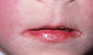 Caso de Bactéria Streptococcus Pyogenes em Ubá é desmentido