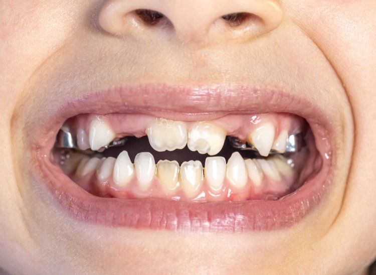 Centro de Especialidades Odontológicas de Ubá oferece tratamento para crianças com dentes desalinhados