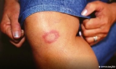 Hanseníase: conheça verdades e mitos sobre a doença